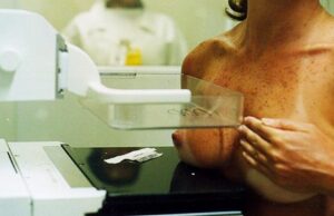 Nova regra antecipa mamografia para mulheres com mais de 40 anos